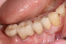 最終補綴物が入った口腔内写真です。インプラントと他の歯が自然な感じで馴染んでいます。
