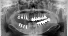 左側上顎の第二大臼歯の欠損を示すパノラマレントゲン写真です。