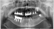 左側上顎第二大臼歯の欠損部に洞粘膜が拳上されたインプラントその周囲に人工骨による不透過像が観察できます。
