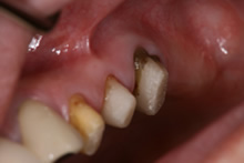 左側上顎の第二大臼歯の欠損を示す口腔内写真です。