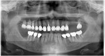 左側上顎の第二小臼歯、第一大臼歯の欠損を示す口腔内写真(左)とレントゲン像(右)です。