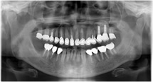サイナスリフトしインプラントを埋入後最終補綴物が入った口腔内写真(左)とレントゲン像(右)です。
