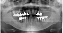 左上の臼歯は既に無く、右は根面カリエスが進行し保存できない状態でした。しかし、この部位は歯槽頂から上顎洞底までの骨がなくサイナスリフトが必要と診断しました。