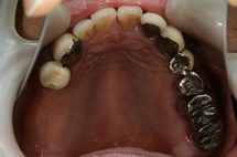術前の口腔内写真です。右上の大臼歯は欠損し、左上の臼歯部は冠が浮き上がり、支台歯が崩壊し適合が失われた状態です。
