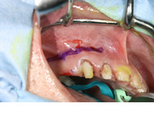 上顎洞にアプローチするために歯肉に切開を入れます。