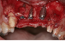 歯槽骨が薄くこのままではインプラントが植わらない状態です。