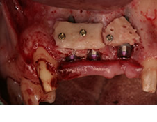 歯槽骨にブロックコツをチタン製のねじにてしっかり止めます。