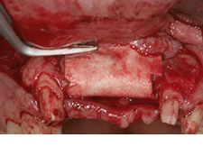 移植した骨が吸収しないようにＧＢＲ法を用います。
吸収性の細胞遮断膜を挿入した口腔内写真です。