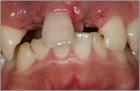 前歯部の２歯欠損