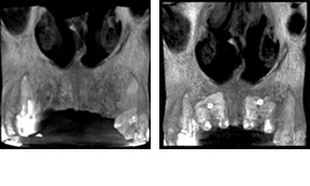 （左写真）手術前のCT像
（右写真）ブロック骨がチタンのネジで顎の骨に固定
