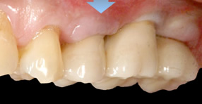治療終了時のお口の写真
奥歯3本がインプラントの人工歯、しっかり噛めて口の中で調和し自然な感じ。