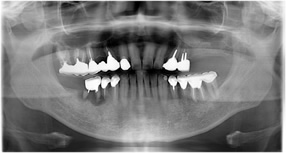 （術前）
左側以外の臼歯部は、ほとんどの歯牙が保存が難しい状態です。