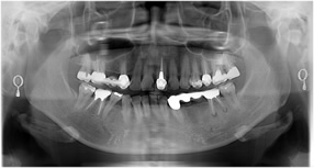 （術前）
左側の下顎の第一大臼歯は破折と根尖病巣のため抜歯となりました。この部分はインプラントによる欠損補綴計画を策定しました。