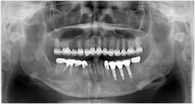 （術後）
左側下顎の欠損部はインプラントにて治療しましたが、骨幅が無くべニアグラフトをしてインプラントを埋入しました。並行して歯周病治療、根っこの治療を十分に行った後最終補綴物を装着したパノラマレントゲン写真です。