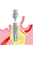 局所麻酔を行い、歯肉を切開してあごの骨にインプラントを埋め込むための穴をあけます
