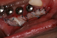 インプラント周囲に、角化歯肉がない部分に口蓋より採取して角化粘膜を移植します。
