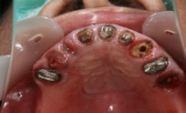 上顎は残っている歯のほとんどが残根状態です。