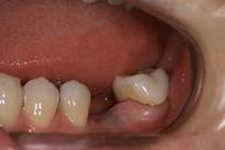 左の下顎の第一大臼歯が欠損しています。